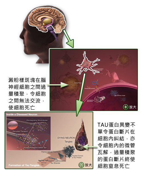 阿爾茨海默症的病因