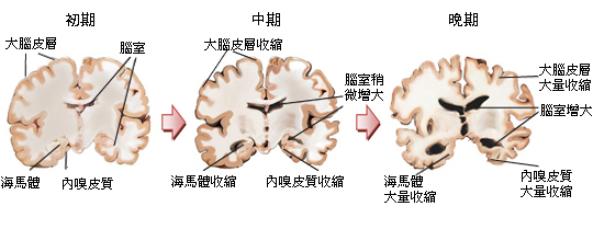 阿爾茨海默症患者腦部變化